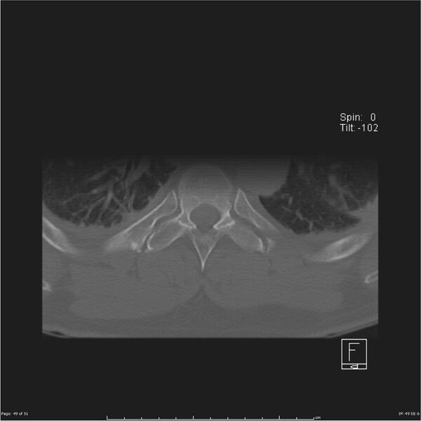 File:Cerebral hemorrhagic contusions and cervical spine fractures (Radiopaedia 32865-33841 C 49).jpg