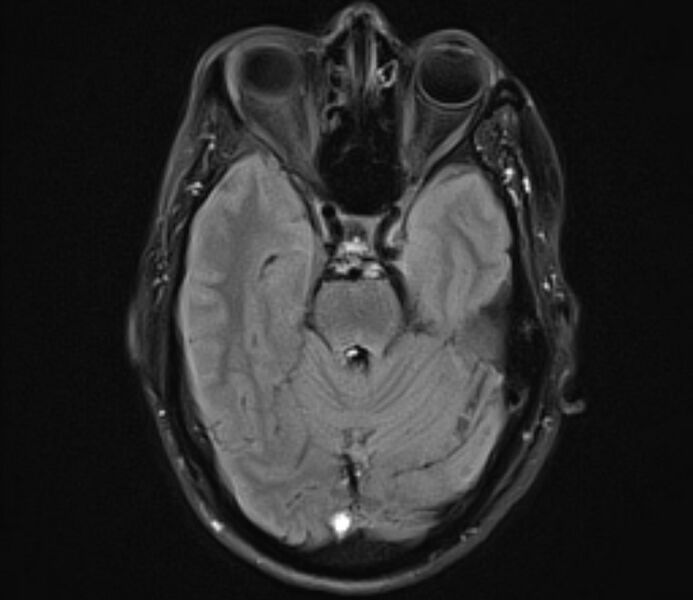 File:Cerebral venous thrombosis (Radiopaedia 71207-81504 Axial FLAIR 10).jpg