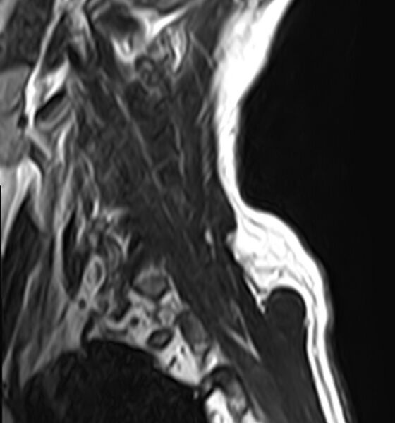 File:Cervical compressive myelopathy (Radiopaedia 71956-82411 C 1).jpg