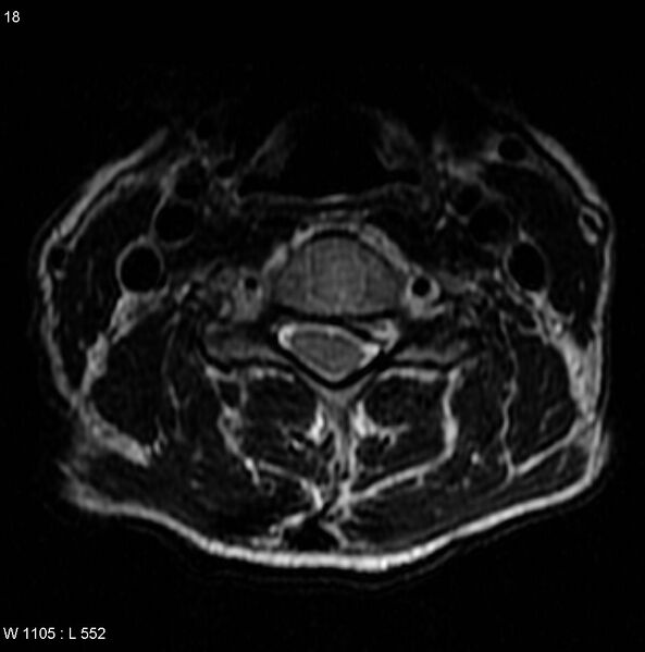 File:Cervical disc extrusion (Radiopaedia 5216-6982 Axial T2 2).jpg