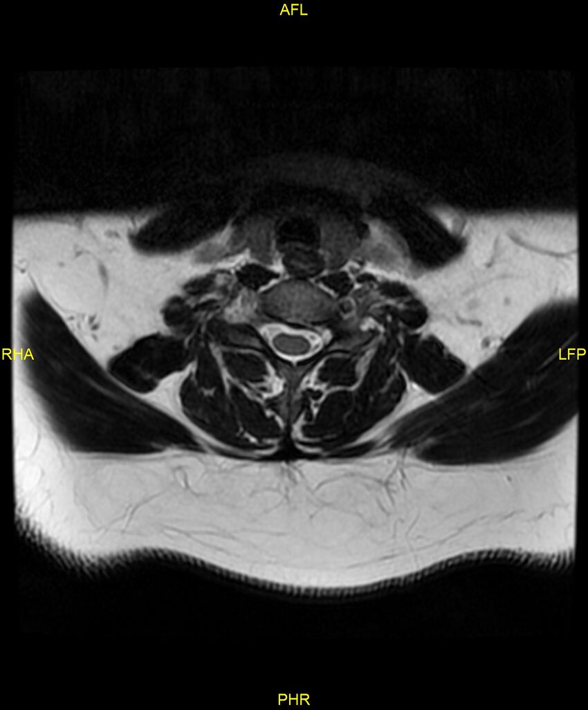 Cervical disc protrusion (Radiopaedia 87147-103415 Axial T2 45).jpg