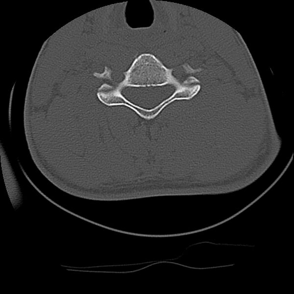 File:Cervical flexion teardrop fracture with cord hemorrhage (Radiopaedia 32497-33454 Axial bone window 52).jpg