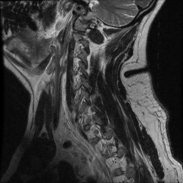 File:Cervical fracture and dislocation with locked facet (Radiopaedia 31837-32781 Sagittal T2 15).jpg
