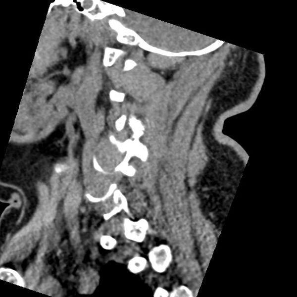 File:Cervical spinal neurofibroma in a patient with NF1 (Radiopaedia 58344-65464 C 13).jpg
