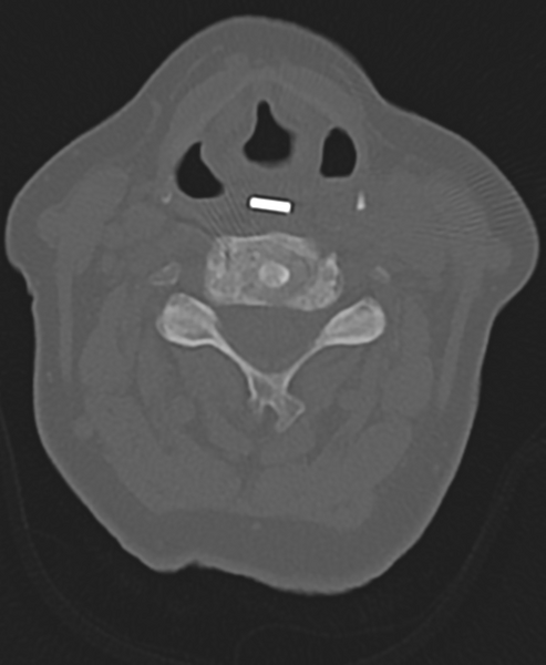 File:Cervical spine ACDF loosening (Radiopaedia 48998-54071 Axial bone window 31).png