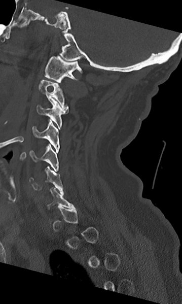 File:Cervical spine fracture - chalk stick (Radiopaedia 39116-41323 Sagittal bone window 41).png