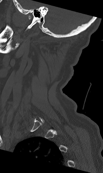 File:Cervical spine fracture - chalk stick (Radiopaedia 39116-41323 Sagittal bone window 51).png