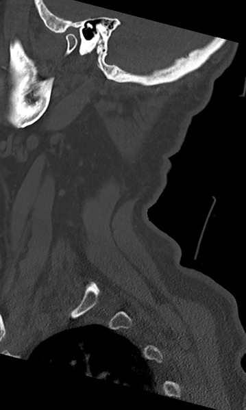File:Cervical spine fracture - chalk stick (Radiopaedia 39116-41323 Sagittal bone window 53).png