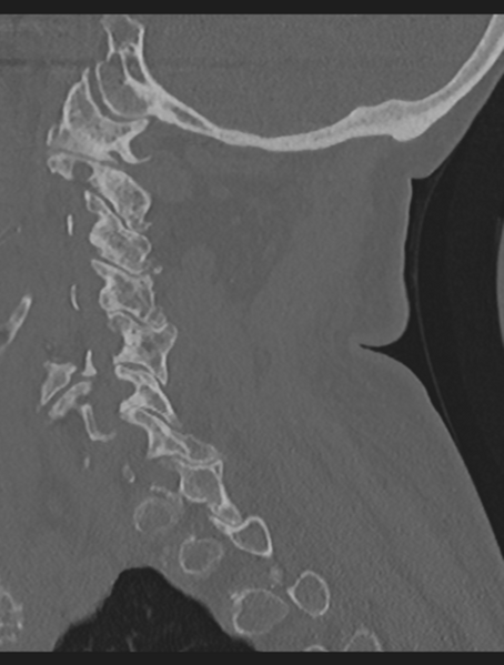 File:Cervical spondylolysis (Radiopaedia 49616-54811 Sagittal bone window 26).png