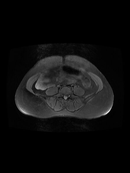 File:Cesarean section scar endometrioma (Radiopaedia 56569-63297 Axial PD fat sat 3).jpg
