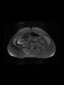 Cesarean section scar endometrioma (Radiopaedia 56569-63297 Axial PD fat sat 3).jpg