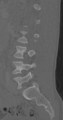 Chance fracture (Radiopaedia 40360-42912 Sagittal bone window 36).png