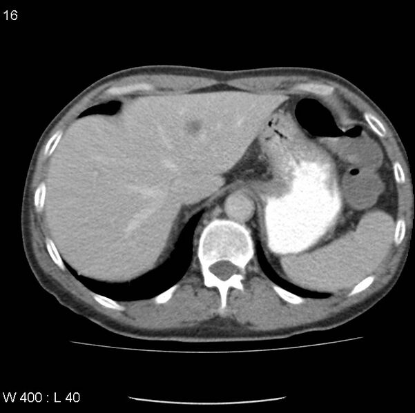 File:Chemotherapy induced enteritis (Radiopaedia 18594-18492 B 9).jpg