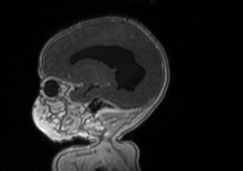 File:Chiari III malformation with occipital encephalocele (Radiopaedia 79446-92559 Sagittal T1 C+ mpr 45).jpg
