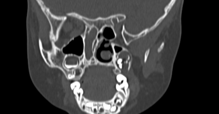 Choanal atresia (Radiopaedia 51295-56972 Coronal bone window 58).jpg