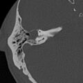 Cholesteatoma (Radiopaedia 15846-15494 bone window 7).jpg