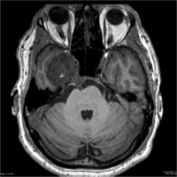 File:Chondrosarcoma of skull base- grade II (Radiopaedia 40948-43654 Axial T1 37).jpg