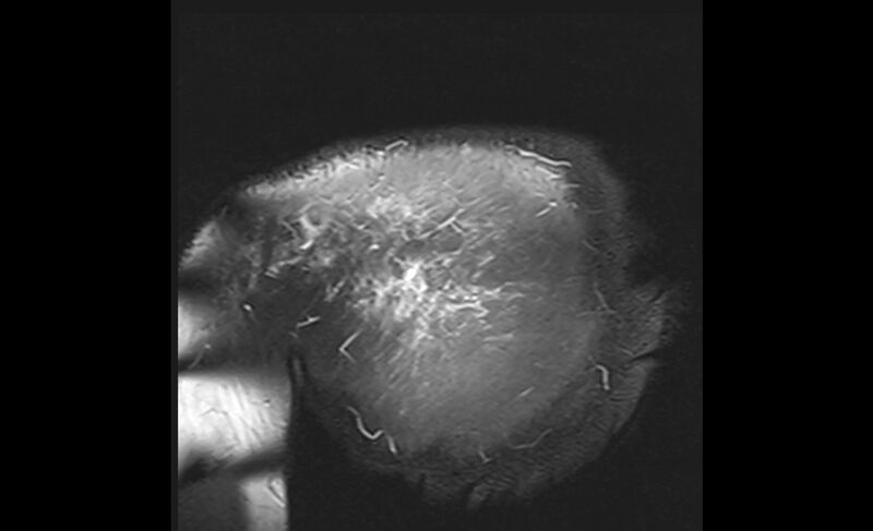 File:Choriocarcinoma in the shoulder (Radiopaedia 28603-28861 Coronal PD FS 32).jpg