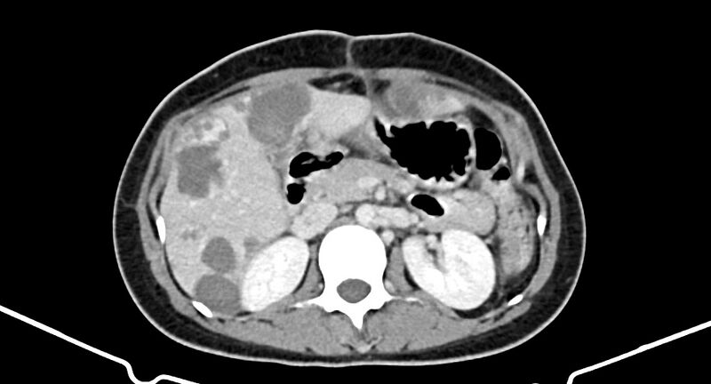 File:Choriocarcinoma liver metastases (Radiopaedia 74768-85766 A 86).jpg