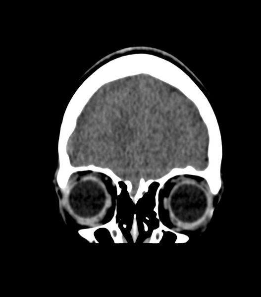 File:Choroid plexus carcinoma (Radiopaedia 91013-108552 Coronal non-contrast 14).jpg