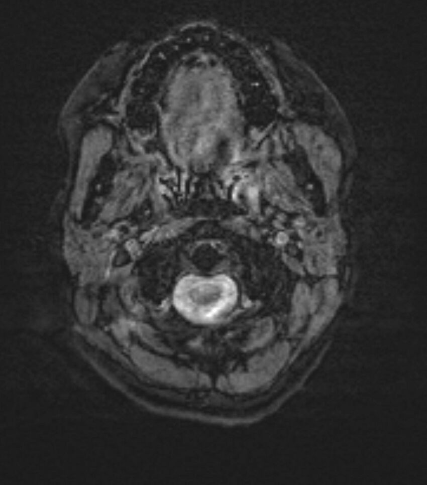 Choroid plexus carcinoma (Radiopaedia 91013-108553 Axial SWI 1).jpg