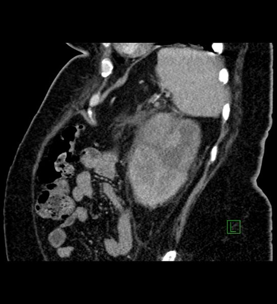 File:Chromophobe renal cell carcinoma (Radiopaedia 84239-99519 D 27).jpg