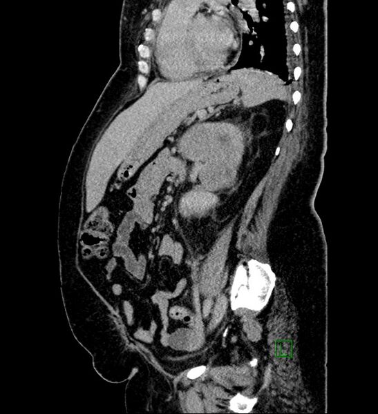 File:Chromophobe renal cell carcinoma (Radiopaedia 84239-99519 G 46).jpg