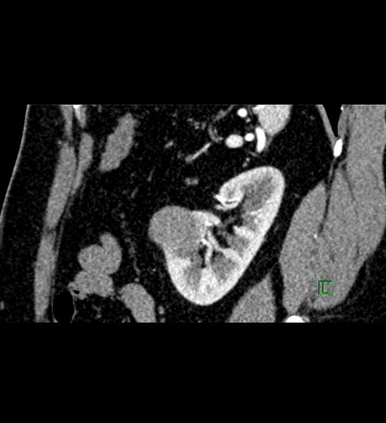 File:Chromophobe renal cell carcinoma (Radiopaedia 84286-99573 F 44).jpg