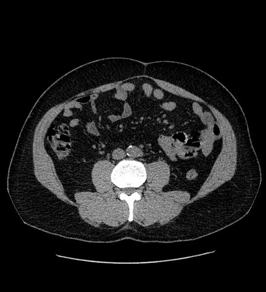 File:Chromophobe renal cell carcinoma (Radiopaedia 84337-99693 Axial non-contrast 83).jpg