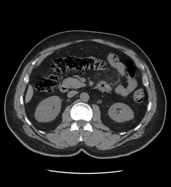 File:Chromophobe renal cell carcinoma (Radiopaedia 86879-103083 Axial non-contrast 40).jpg