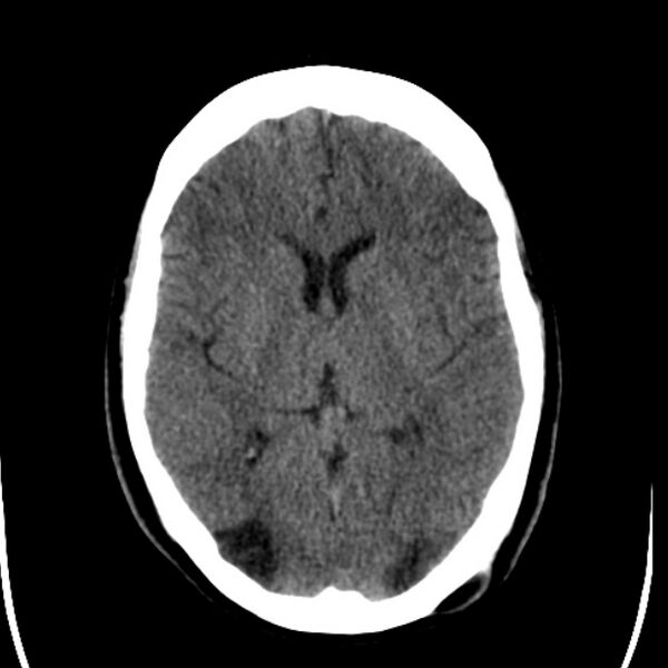 File:Chronic bilateral occipital lobe infarcts (Radiopaedia 31276-31996 Axial non-contrast 22).jpg