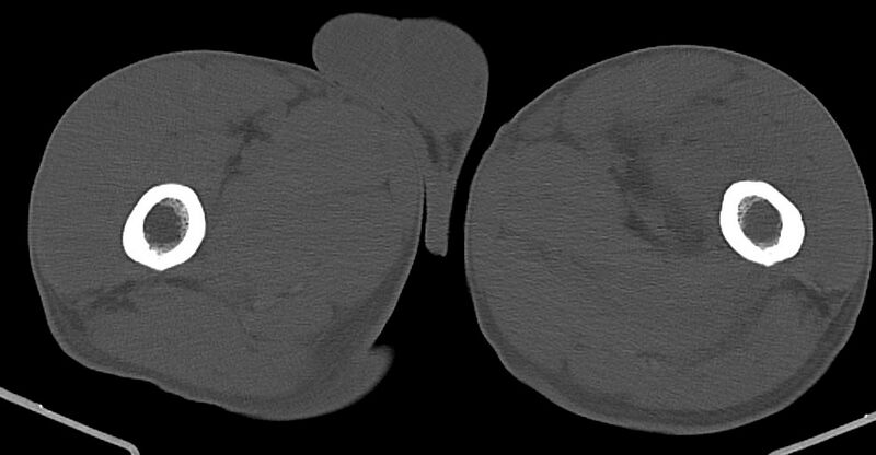 File:Chronic osteomyelitis (with sequestrum) (Radiopaedia 74813-85822 Axial non-contrast 69).jpg