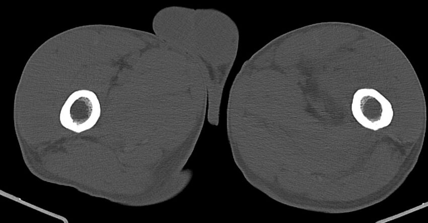 Chronic osteomyelitis (with sequestrum) (Radiopaedia 74813-85822 Axial non-contrast 69).jpg