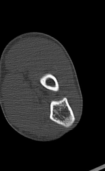 File:Chronic osteomyelitis of the distal humerus (Radiopaedia 78351-90971 Axial 68).jpg