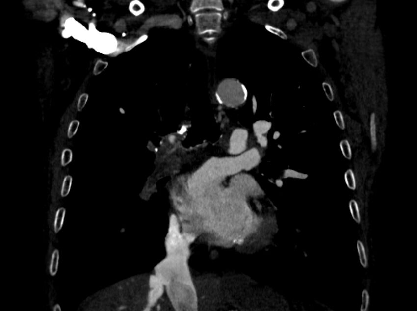 Chronic pulmonary embolism (Radiopaedia 91241-108843 A 56).jpg