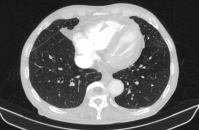File:Chronic pulmonary embolism (Radiopaedia 91241-108843 Axial lung window 68).jpg