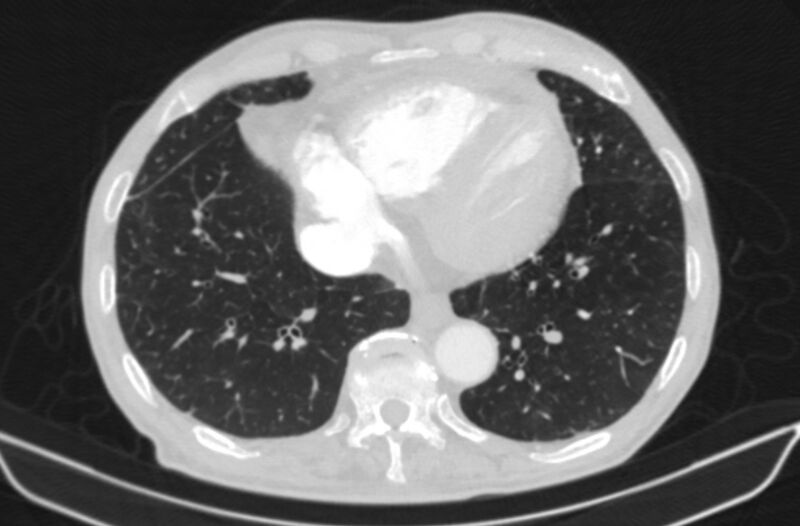 File:Chronic pulmonary embolism (Radiopaedia 91241-108843 Axial lung window 69).jpg