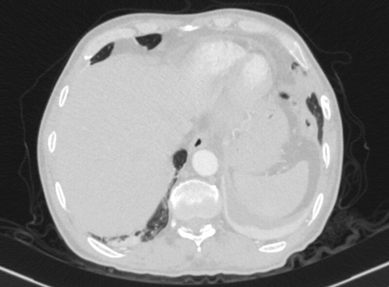 File:Chronic pulmonary embolism with bubbly consolidation (Radiopaedia 91248-108850 Axial lung window 133).jpg