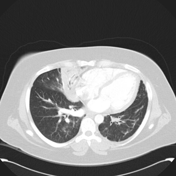 File:Chronic thromboembolic pulmonary hypertension (CTEPH) (Radiopaedia 74597-85531 Axial lung window 32).jpg