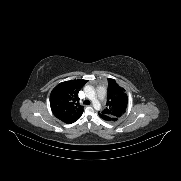 File:Chronic thromboembolic pulmonary hypertension (CTEPH) (Radiopaedia 74597-85532 Axial C+ CTPA 111).jpg