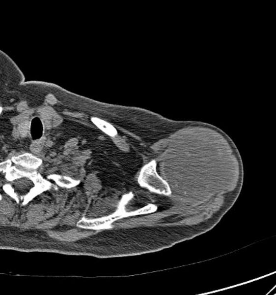 File:Clear cell chondrosarcoma - humerus (Radiopaedia 63104-71612 Axial non-contrast 23).jpg