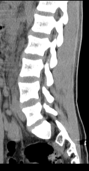 File:Clear cell meningoma - lumbar spine (Radiopaedia 60116-67691 A 18).png