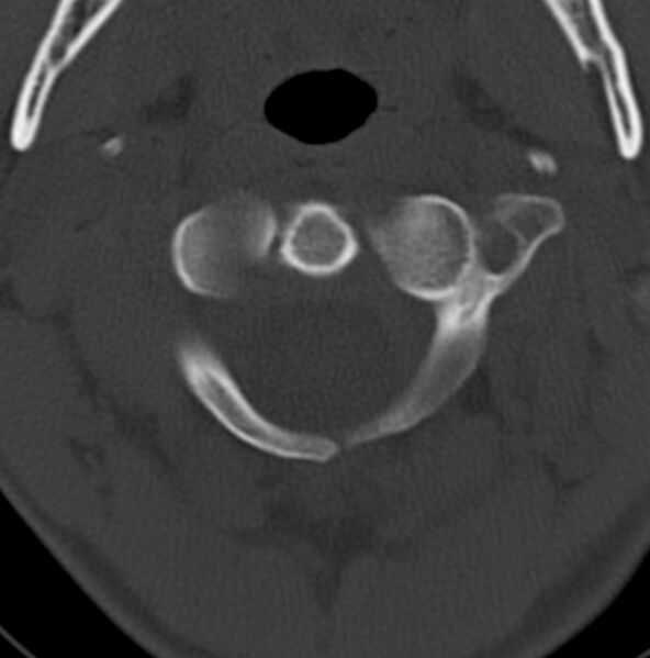 File:Cleft of the posterior arch of C1 mimicking fracture (Radiopaedia 40201-42721 Axial bone window 14).jpg