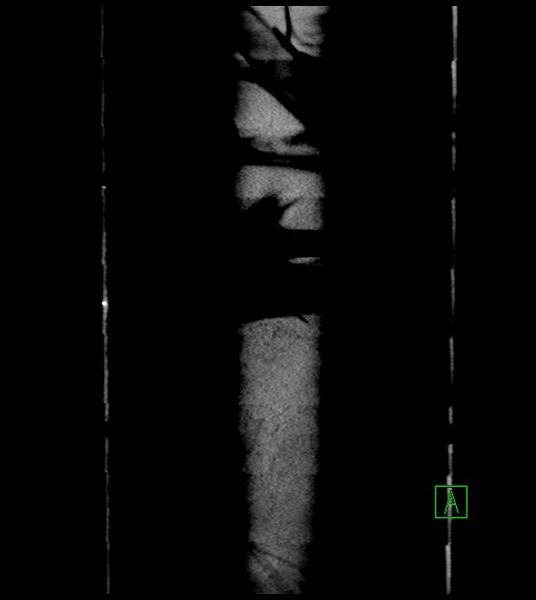 File:Closed-loop small bowel obstruction-internal hernia (Radiopaedia 78439-91096 Coronal non-contrast 109).jpg
