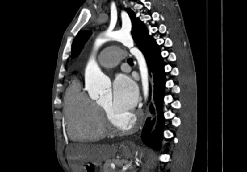 File:Coarctation of aorta with aortic valve stenosis (Radiopaedia 70463-80574 B 83).jpg