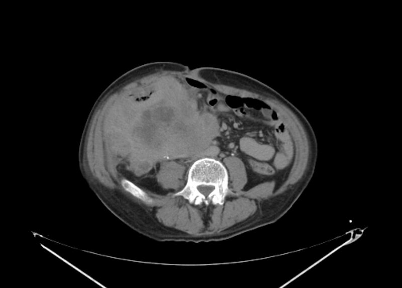File:Colon cancer mimicking renal cell carcinoma (Radiopaedia 28986-29335 Axial C+ delayed 45).jpg