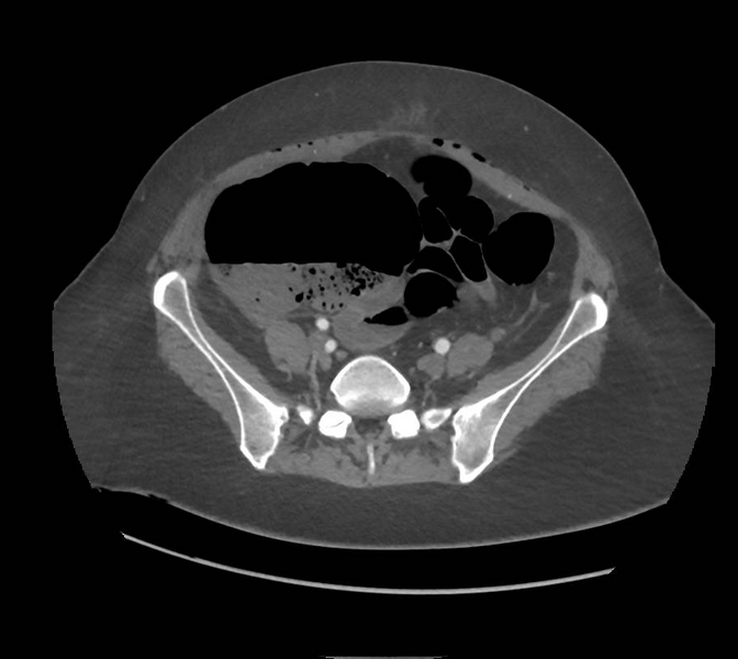 File:Colonic pseudo-obstruction (Radiopaedia 79752-92980 A 136).png