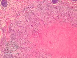 Lupus miliaris disseminatus faciei/pathology