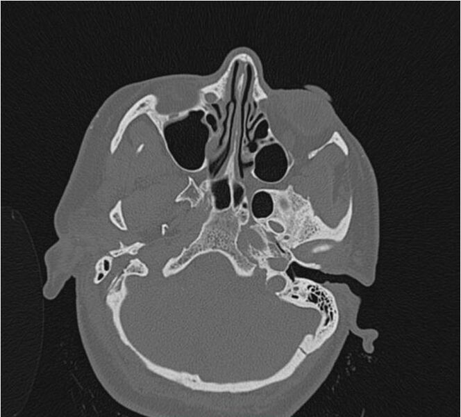File:Nasolabial cyst (Radiopaedia 25322-25580 Axial bone window 16).jpg