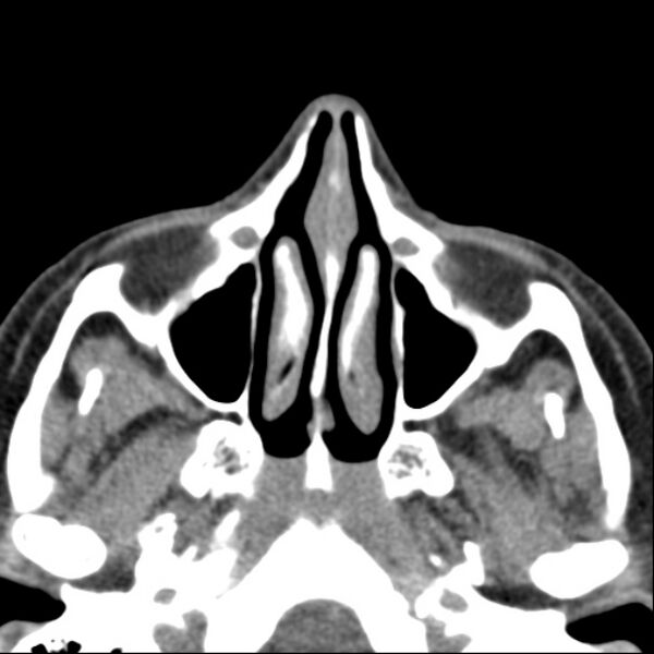 File:Nasolabial cyst (Radiopaedia 33987-35205 Axial non-contrast 23).jpg